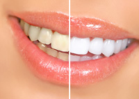 Teeth Whitening | Dentist In Flint, MI | Mid Michigan Dental Group